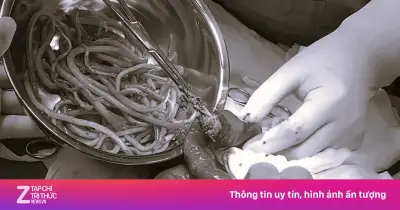 Bất ngờ nội soi phát hiện hai con giun đũa dài 30 cm trong đường mật bệnh nhi 12 tuổi