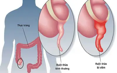 Chủ quan đau bụng âm ỉ vì nghĩ rối loạn tiêu hóa, người đàn ông suýt vỡ ruột thừa