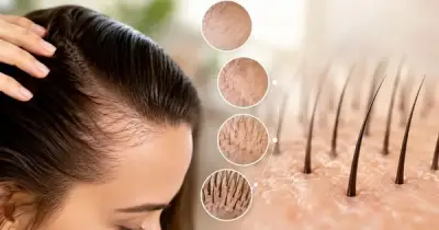Cơn sốt Minoxidil: Giải pháp khoa học cứu cánh cho mái tóc thưa