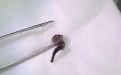 Gắp đỉa sống dài 2,5cm trong mũi nam thanh niên do uống nước suối