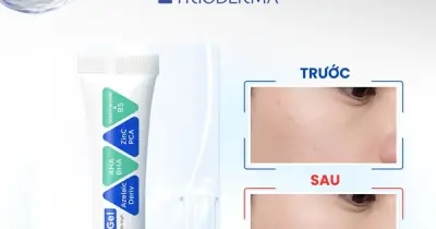 Kem chấm mụn Trioderma Anti Acne Gel có thực sự hiệu quả? Bí mật đằng sau cơn sốt cháy hàng