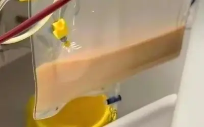 Mẫu máu trắng đục như sữa dâu vì viêm tụy cấp sau những bữa nhậu