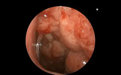 Nam bệnh nhi 14 tuổi suy kiệt vì ung thư vòm họng do tự mua thuốc