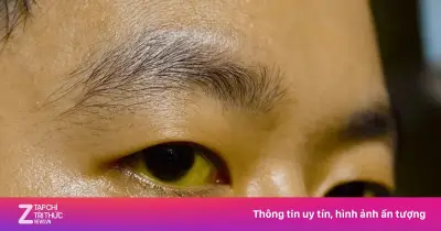 Phân biệt viêm gan A, B, C, D, E: 3 nhóm chính cần nhớ