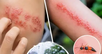 Phân biệt zona thần kinh và viêm da do kiến ba khoang: Dấu hiệu và cách xử trí