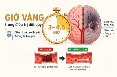 Phát hiện sớm đột quỵ: 'Giờ vàng' quyết định khả năng hồi phục