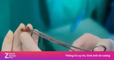 Đốt trĩ tại phòng khám tư, người đàn ông 64 tuổi bị hẹp hậu môn nặng