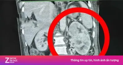 Tiểu ra máu và đau hông: Dấu hiệu ung thư thận giai đoạn cuối dễ nhầm