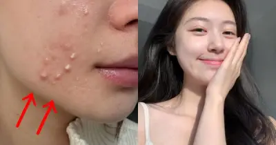 Top 4 kem chấm mụn giúp xẹp mụn sau một đêm, không lo sẹo