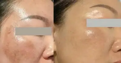 Top 5 serum mờ nám mảng giúp da trắng hồng sau 4 tuần