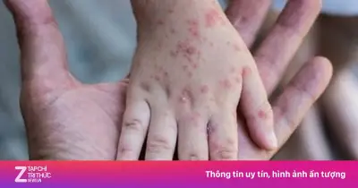 Trẻ bị tay chân miệng: Khi nào cần đưa đi viện ngay?