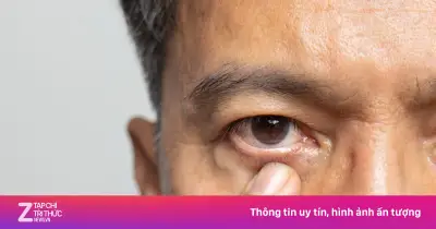 Tát mắt phải vì sợ xui, người đàn ông bị bong võng mạc mất thị lực
