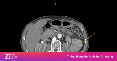 Ung thư thận âm thầm: Khối u tăng gấp đôi sau 4 tháng, phải cắt toàn bộ thận
