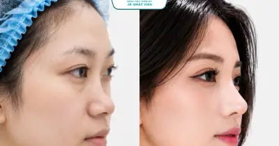 Xóa mũi tẹt cho thanh thiếu niên Việt: Cơ hội nâng mũi miễn phí gần 100 triệu đồng