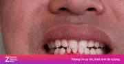 4 dấu hiệu cảnh báo gan tổn thương qua khuôn mặt