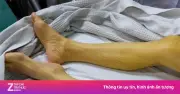 6,5 triệu người Việt mắc viêm gan B: Quy tắc '4 nên, 1 không'