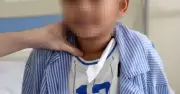 Bé 8 tuổi mắc ung thư tuyến giáp từ dấu hiệu rất dễ bị bỏ qua