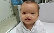 Bé trai 8 tháng tuổi bị bỏ rơi trước cổng chùa cần phẫu thuật dị tật môi hàm ếch