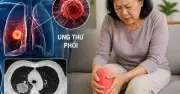 Bác sĩ cảnh báo 3 dấu hiệu ung thư phổi từ chân, nhiều người chủ quan