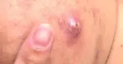 Bác sĩ cảnh báo không tự nặn mụn đầu đinh vì nguy cơ tử vong