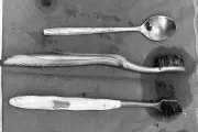 Bác sĩ phẫu thuật lấy 2 bàn chải và thìa inox trong dạ dày bệnh nhân tự kỷ