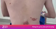 Bệnh đường tình dục gia tăng, xu hướng đồng nhiễm nhiều tác nhân đáng lo ngại