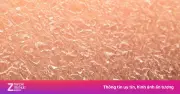 Bệnh vảy cá bẩm sinh: Dễ nhầm với khô da, nguy hiểm nếu phát hiện muộn