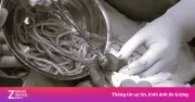 Bất ngờ nội soi phát hiện hai con giun đũa dài 30 cm trong đường mật bệnh nhi 12 tuổi