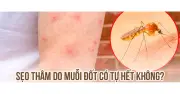 Cách trị sẹo thâm do muỗi đốt và côn trùng cắn hiệu quả tại nhà