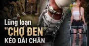 Chợ đen phẫu thuật kéo dài chân: Hơn 1,5 tỷ đồng đổi lấy từng milimét và những ca mổ không lộ mặt bác sĩ