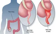Chủ quan đau bụng âm ỉ vì nghĩ rối loạn tiêu hóa, người đàn ông suýt vỡ ruột thừa