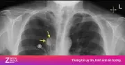 Ho kéo dài không khỏi, người đàn ông 71 tuổi phát hiện ung thư phổi