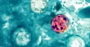 Mỹ điều tra ký sinh trùng cyclospora gây tiêu chảy tại 18 bang