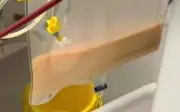 Mẫu máu trắng đục như sữa dâu vì viêm tụy cấp sau những bữa nhậu