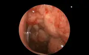 Nam bệnh nhi 14 tuổi suy kiệt vì ung thư vòm họng do tự mua thuốc