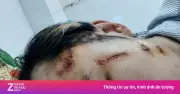 Nam shipper bị đánh nứt sọ vì mâu thuẫn đổi trả hàng 2,3 triệu đồng