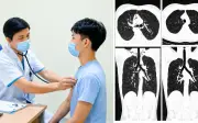 Nam thanh niên 20 tuổi tràn khí trung thất sau ho kéo dài một tuần