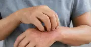 Ngứa ở 2 vị trí trên cơ thể có nguy cơ là dấu hiệu xơ gan