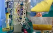 Người phụ nữ 45 tuổi máu trắng đục như sữa vì tự ý ngừng thuốc mỡ máu
