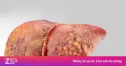 Người phụ nữ 62 tuổi sống chung viêm gan B không triệu chứng, nhập viện phát hiện xơ gan F4