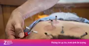 Người trẻ đổ xô đi châm cứu, xoa bóp vì đau cổ vai gáy