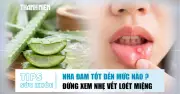 Nha đam và lợi ích sức khỏe: Cảnh giác vết loét miệng kéo dài