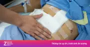 Phát hiện cùng lúc ung thư gan và thực quản nhờ nội soi trước mổ