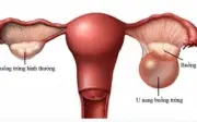Phát hiện u buồng trứng khổng lồ 15cm sau 2 năm bỏ tái khám