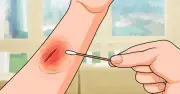 Quy trình chăm sóc vết thương hở đúng cách từ sơ cứu đến phục hồi