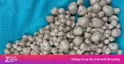 Sỏi thận âm thầm gây suy thận: Dấu hiệu và cách phòng ngừa