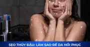 Sẹo thủy đậu có tự hết không? Bí quyết mờ sẹo sau 4 tuần kể cả lâu năm