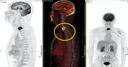 Sốt nhẹ 2 tháng, đốt sống cổ bị vi khuẩn 'đục thủng' vì thói quen trong bếp