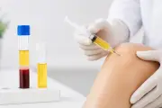 Tiêm PRP điều trị thoái hóa khớp gối: Cơ chế, hiệu quả và lưu ý