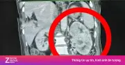 Tiểu ra máu và đau hông: Dấu hiệu ung thư thận giai đoạn cuối dễ nhầm